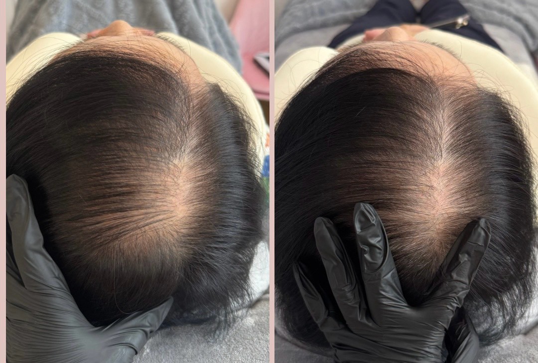 60+ 女生頭皮管理前後對照：髮分線（更年期落髮）