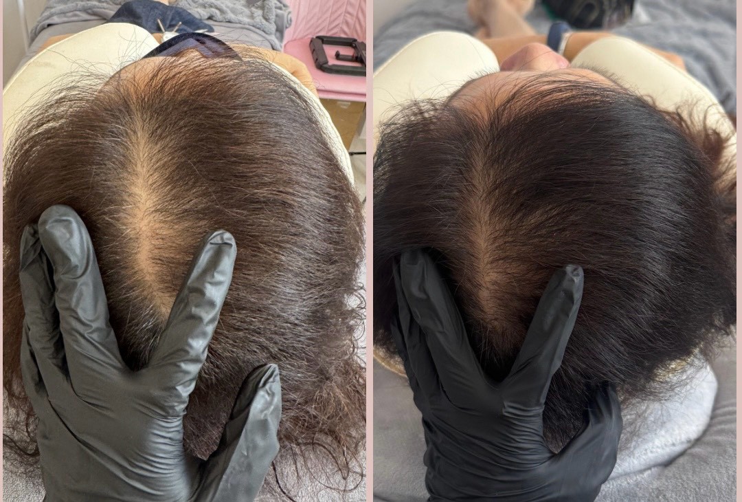 60+ 女生頭皮管理前後對照：髮分線（更年期落髮）
