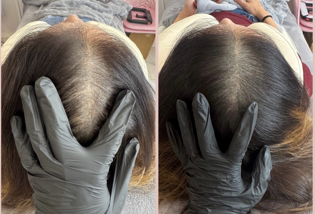 50+ 女生頭皮管理前後對照：髮分線（更年期落髮、作息）