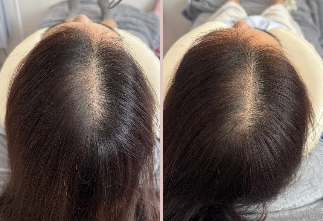 30+ 女生頭皮管理前後對照：髮分線（產後落髮、作息、胃繞道手術）
