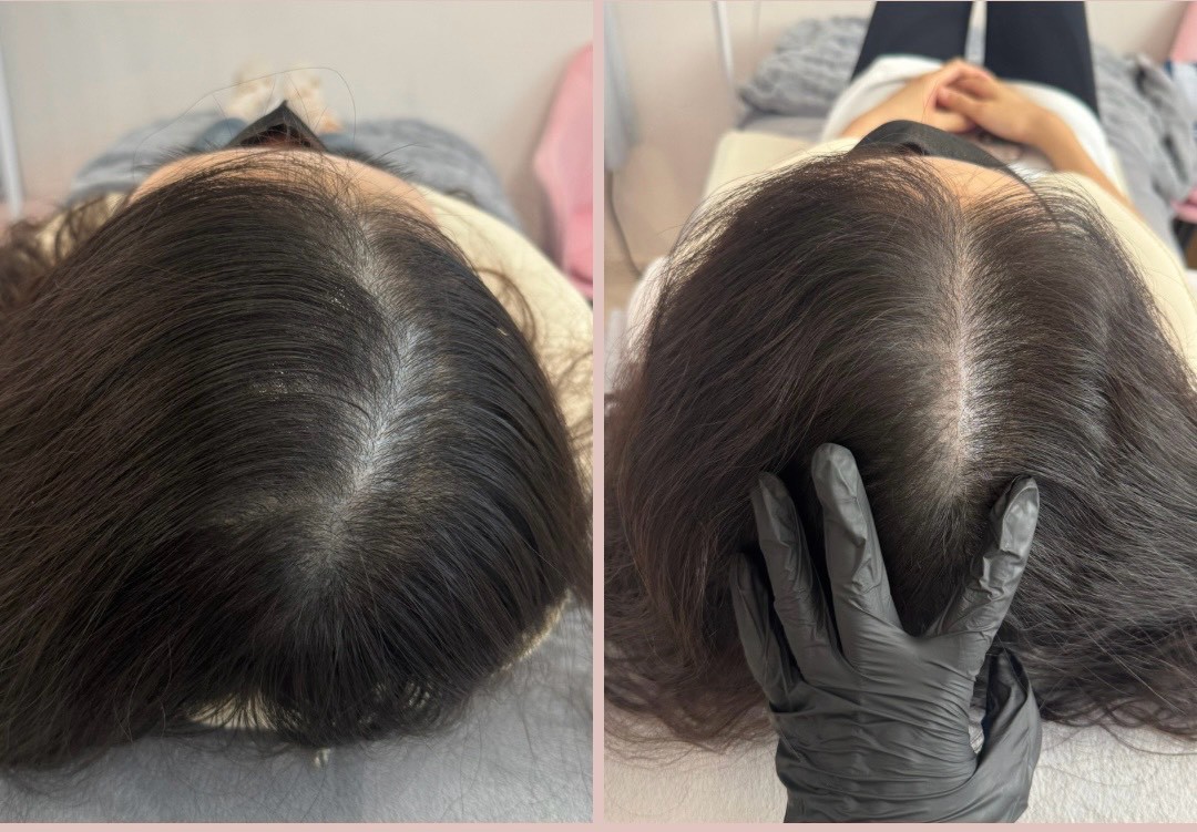 30+ 女生頭皮管理前後對照：髮分線（產後落髮、作息）