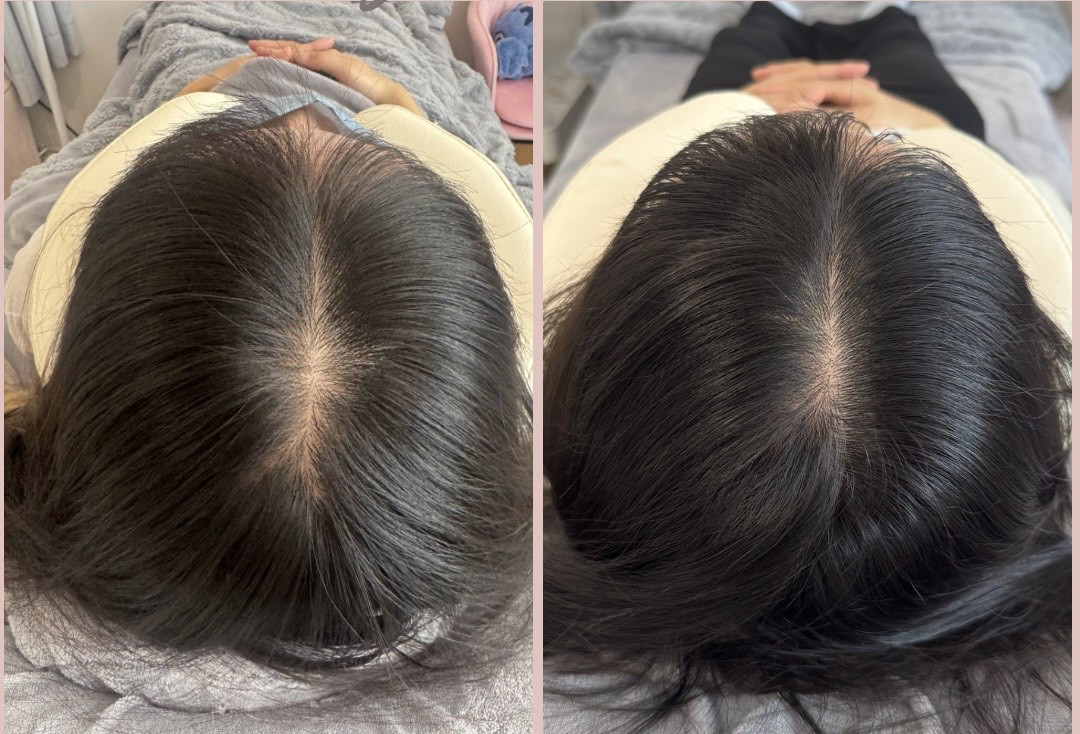 20+ 女生頭皮管理前後對照：髮分線（壓力、作息）