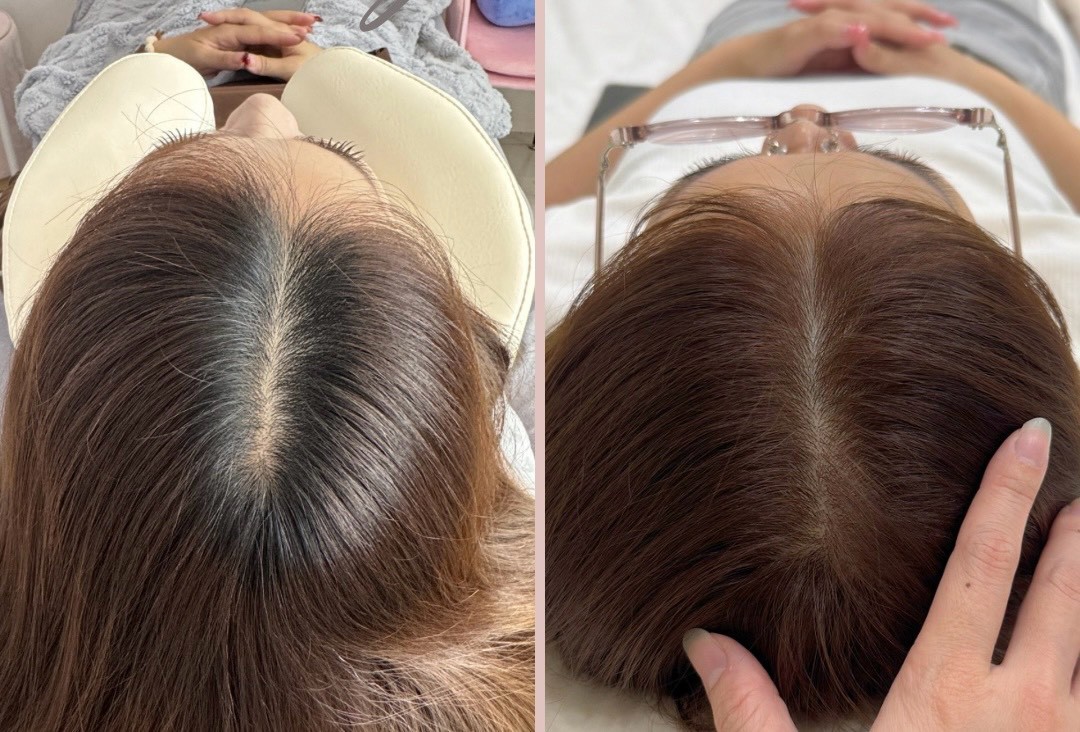 30+ 女生頭皮管理前後對照：髮分線（壓力、作息）