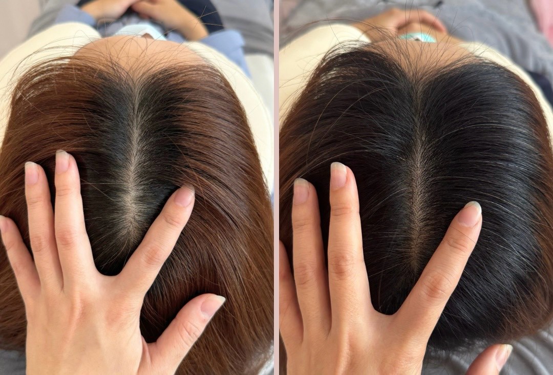 30+ 女生頭皮管理前後對照：髮分線（壓力、作息）
