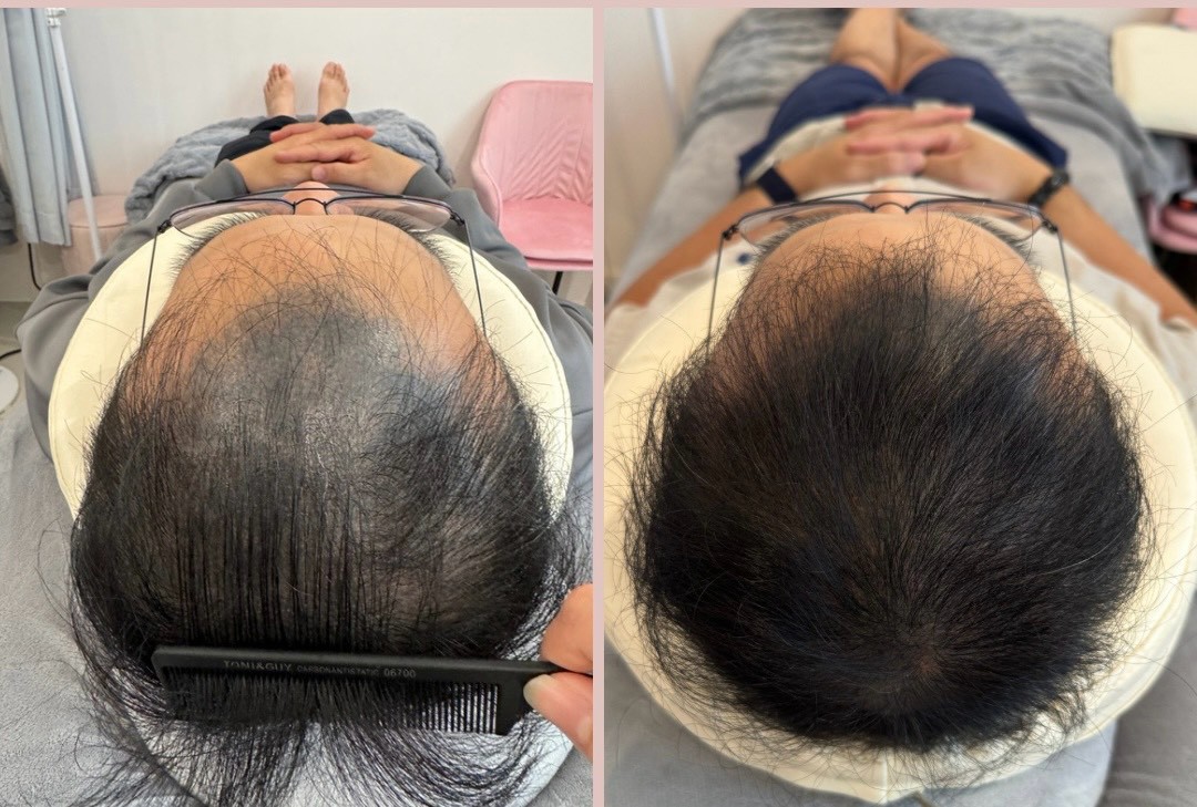 40+ 男生頭皮管理前後對照：髮際線、髮旋（雄性禿）